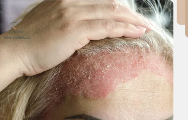 Eczema & Psoriasis: A Root Cause Approach
