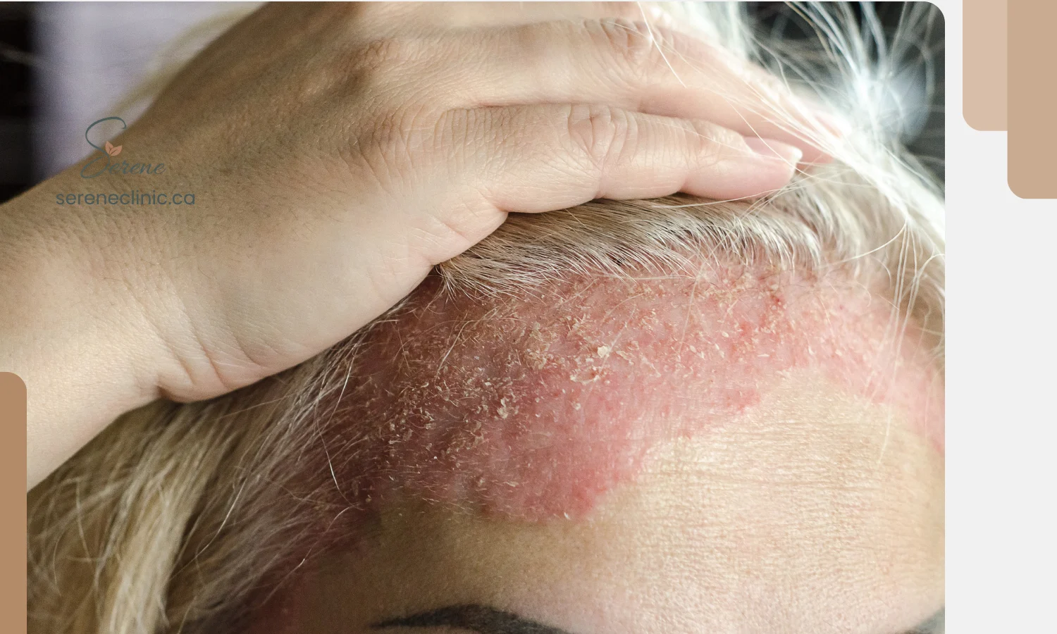 Eczema & Psoriasis: A Root Cause Approach