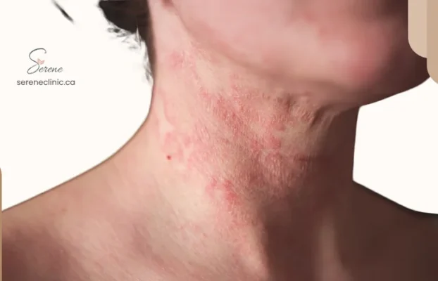 What Is Triggering My Eczema? Why Food Isn’t Always the Answer