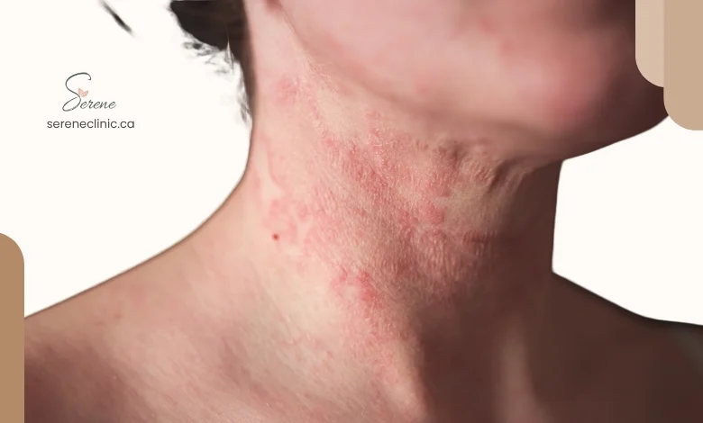 What Is Triggering My Eczema? Why Food Isn’t Always the Answer